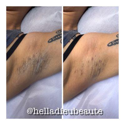 Before & after underarms wax