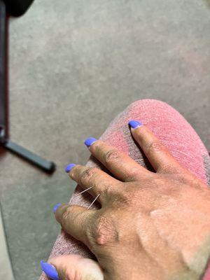 Acupuncture for neck and shoulder pain