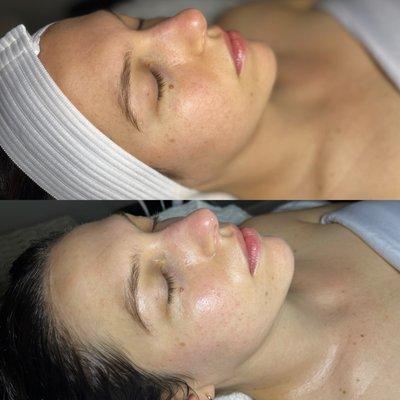Oxygen RX Facial