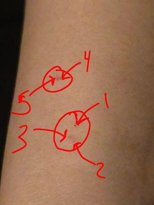 Clearer five stabs with a needle. No injection happened