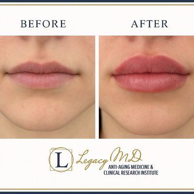 Lip augmentation. Beautiful lips