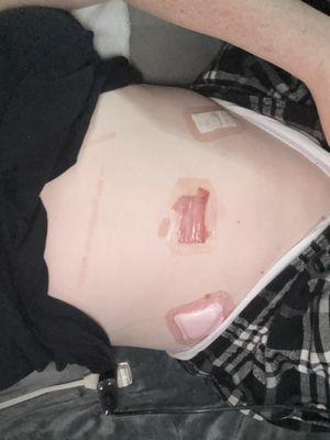 Very need work to remove ovarian cyst!