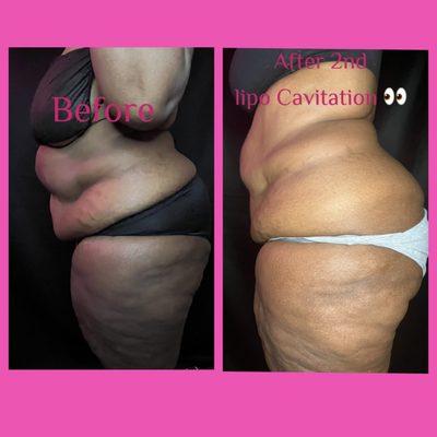 This is her second Laser Lipo Cavitation Session and already seeing results !