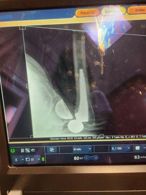 Before and after hip dislocation.