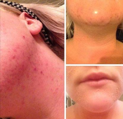 Chemical peels, dermaplanning and waxing.