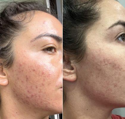 Tina and her team at Total Derma Care saved my skin. Here are some before and after results from her skin care plan.