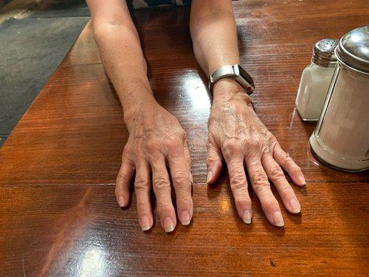 funny looking functional hand. YAY! Continuing to the improve just as Dr Amis said it would. God bless him!