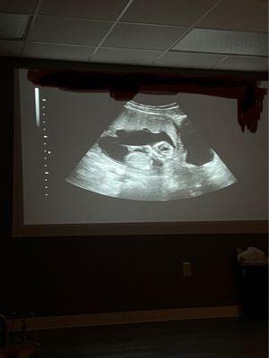Ultrasound projector.