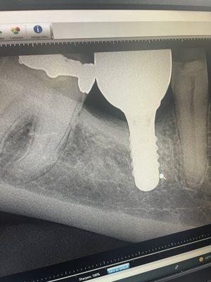 The implant should have been placed parallel to the adjacent molar, so there are no major gaps.
