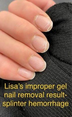 Lisa's improper gel nail removal resulting in splinter hemorrhage, brittle, sides detached from violent pulling.