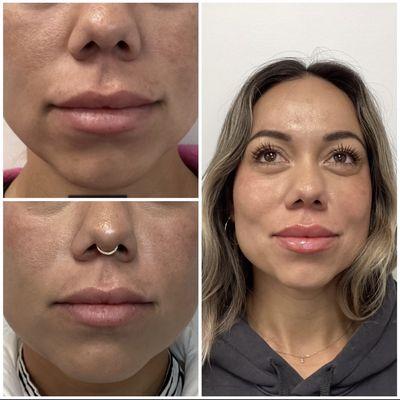 Lip injection (Rehab)