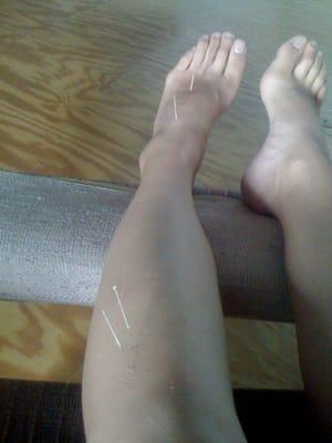 Acupuncture needles in my left foot and leg to treat joint pain in my right thumb and arm. Pretty amazing and effective.