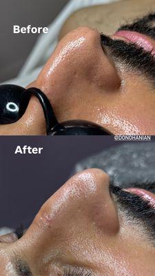Before and after black heads removal and pores!