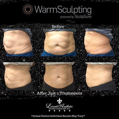 Fantastic results with WarmSculpting by SculpSure