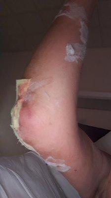 This is the reason why I couldn't fix my own catheter