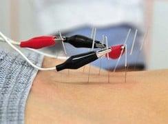 Electro Acupuncture