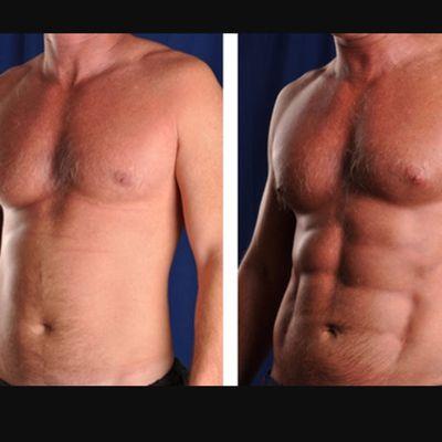 Liposculpture of Upper & Lower Abdomen