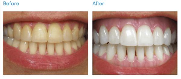 Our patient had always wanted whiter teeth. After an hour she has her dream smile!