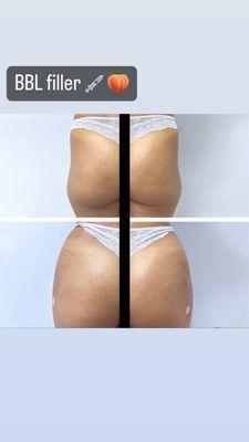 BBL fillers