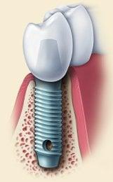 dental implant