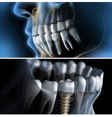 We love to do implants