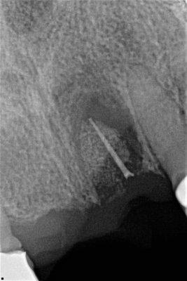 botched surgery on left incisor root remnant