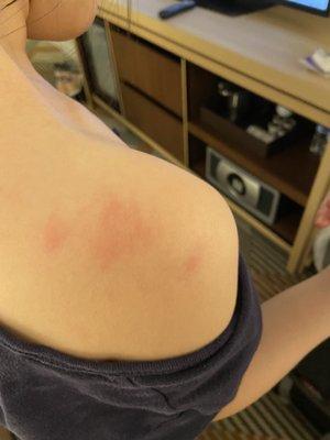 Bug bites