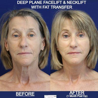 Deep Plane Facelift with Fat Transfer and Necklift. Dr. Jason Cooper in Palm Beach, Florida is an expert in deep plane facelift and necklift