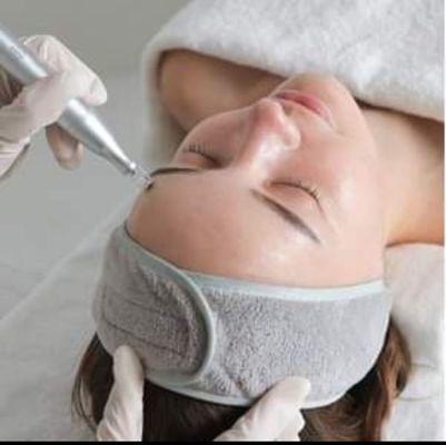 Microneedling
