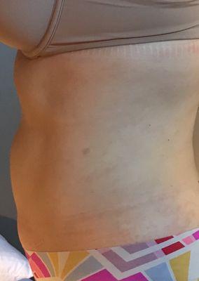 $8,000 liposuction 6 month result on 150lb female