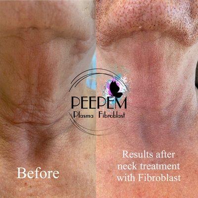 Peepem Pasma Fibroblast