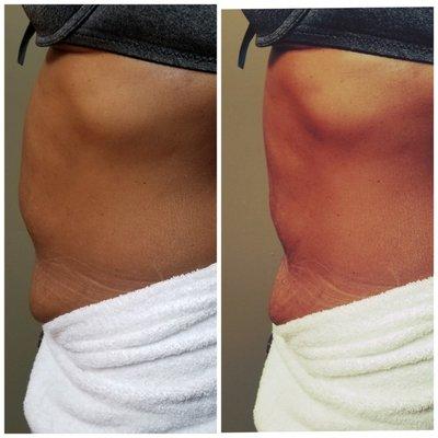 Before and after 1 Session