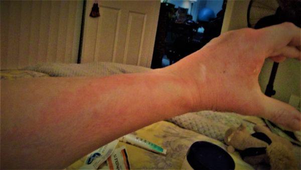 Fire Ants bites Broadwater Apartments, Galveston, TX .  The red streaks are the venom.  The second photo is what the venom does to you.