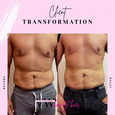 RF Skin Tightening- for flabby or loose skin due to weightloss and/or pregnancy