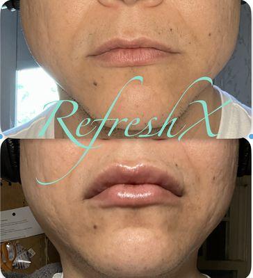 Before and after of lip filler and lip flip.