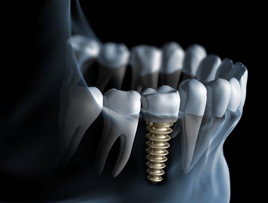 Peter Glavas,DDS -Ideal Dental Implants