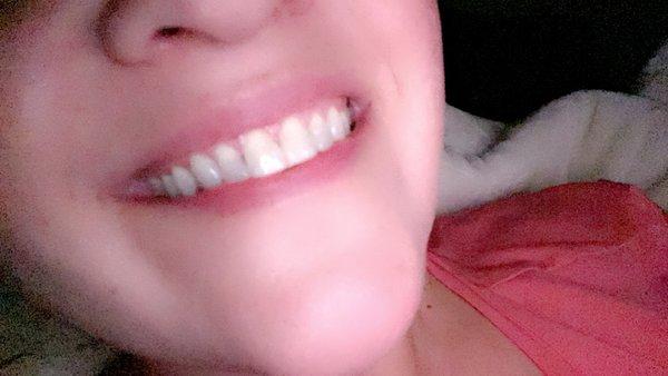 My front teeth after !! Just wow
