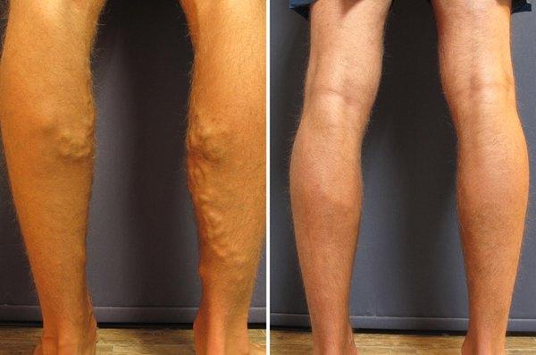 California Vein Specialists