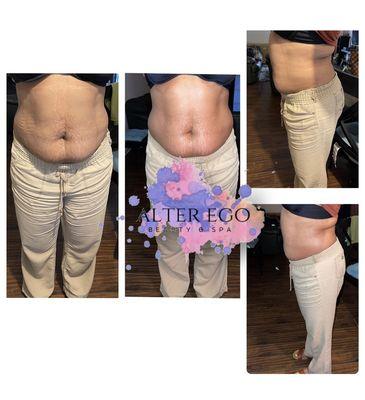 Sasha Fierce Laser Lipo and Skin Tightening Treatment