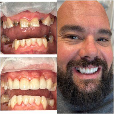 Upper Zitconia Fixed Bridge and lower Bioclear bonding