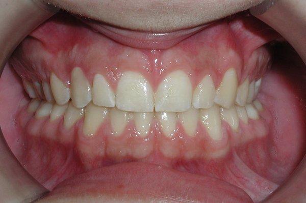 after orthodontics and gingivoplasty