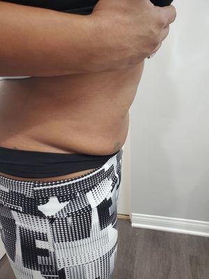 Ultrasonic Cavitation Helps to remove stubborn fat. Series are recommended. Water water water and 30 minutes of exercise is key.