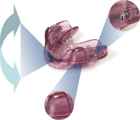 Oral Appliance for Snoring and Sleep Apnea