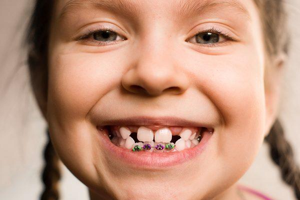 Schedule a complimentary consultation to see if your child needs Orthodontic treatment.