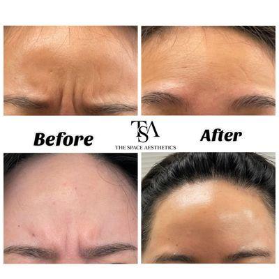 Botox injection for "11" line