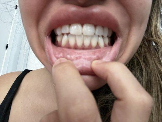 After bottom left and right canines still crooked what did I pay for?