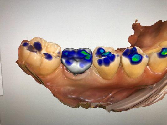 My custom designed crown!!! So exciting