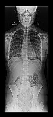 X-ray of scoliosis
