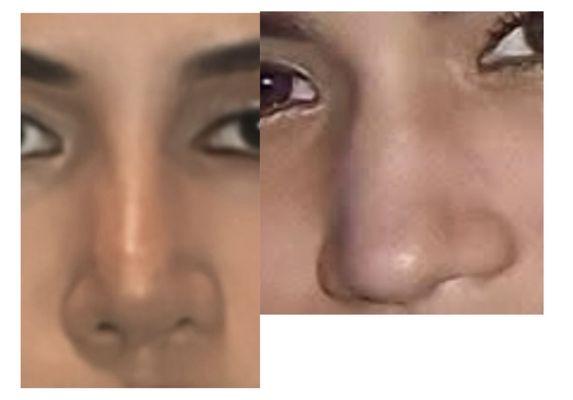 After/ Before Non - surgical rhinoplasty
