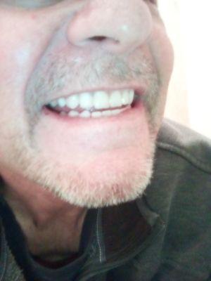 New dentures!